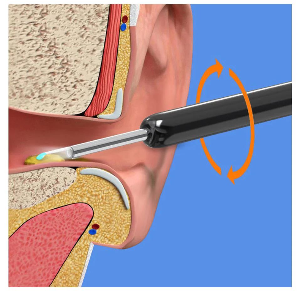 Earwax Removal Kit - Arabinox