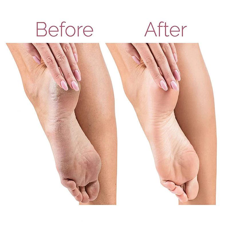 Electric Pedicure Foot File Callus Remover - Arabinox