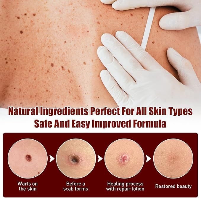 tags and moles remover - Arabinox