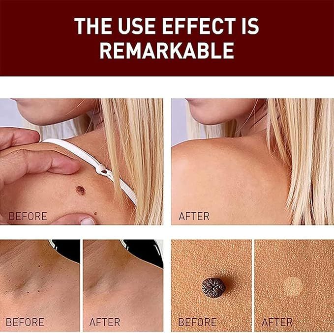 tags and moles remover - Arabinox